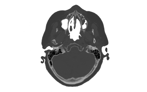 <p>Patient underwent Computed Tomography (CT). Surgeon initiated new case in MICE and uploaded patient‘s CT data</p>
