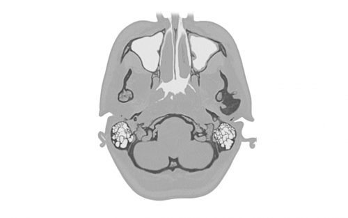 <p>Patient underwent Computed Tomography (CT). Surgeon initiated new case in MICE and uploaded patient‘s CT data</p>
