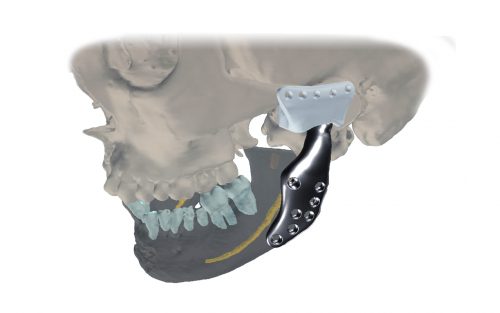 <p>After taking into account provided specifications and cephalometric measurements, patient-specific implant and surgical guides have been designed. Furthermore, mandible position correction was planned for restoring facial symmetry and proper occlusion. Surgeon validates the design of endoprosthesis components and surgical guides, as well as other features of device package</p>
