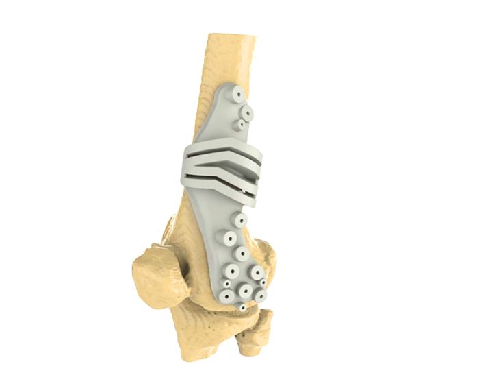 Patient-specific surgical guides for femoral osteotomy